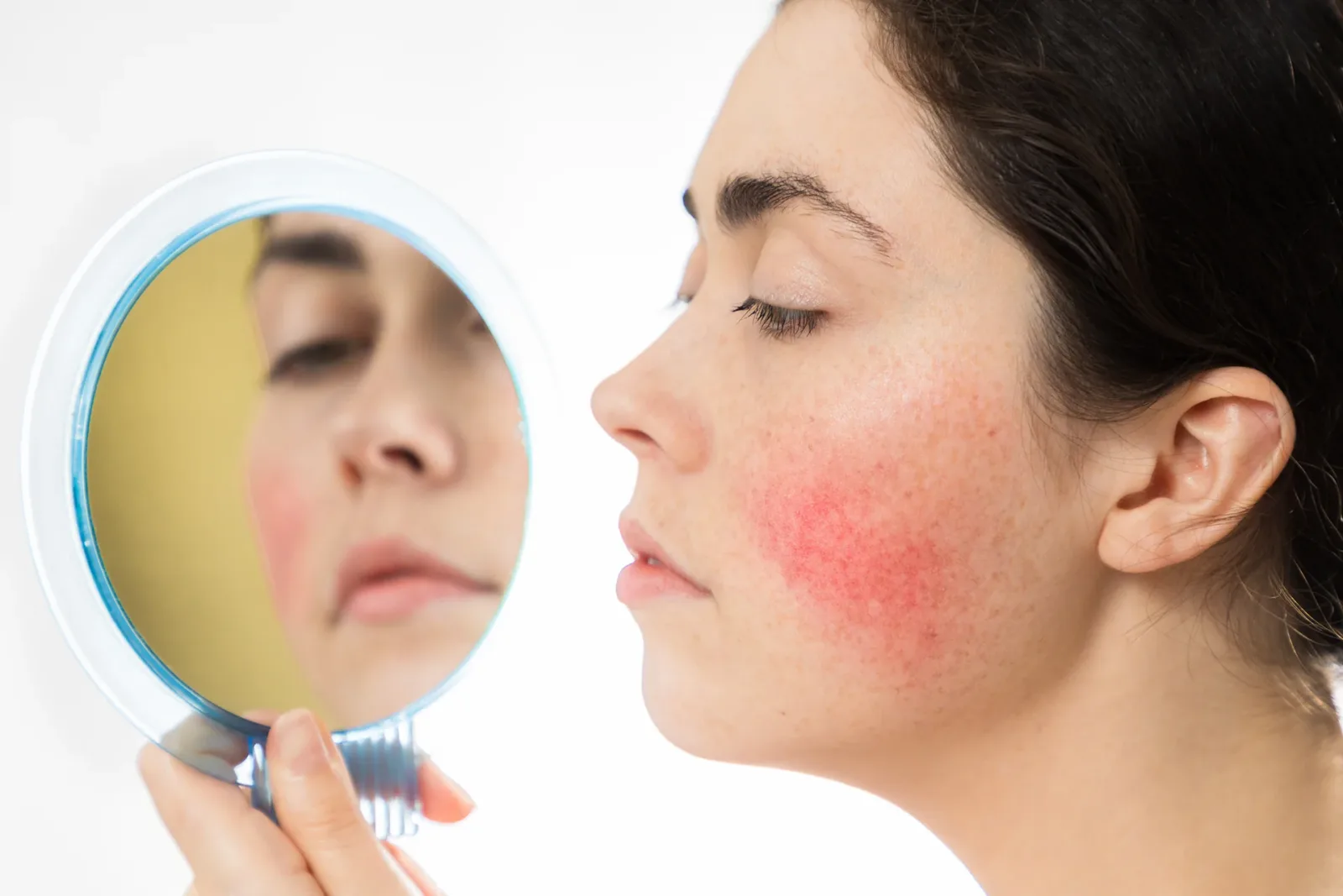 DAO Enzyme and Rosacea: Understanding the Link