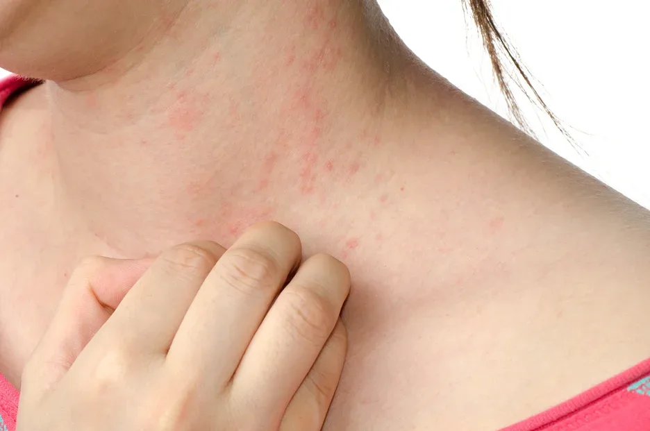 skin allergy