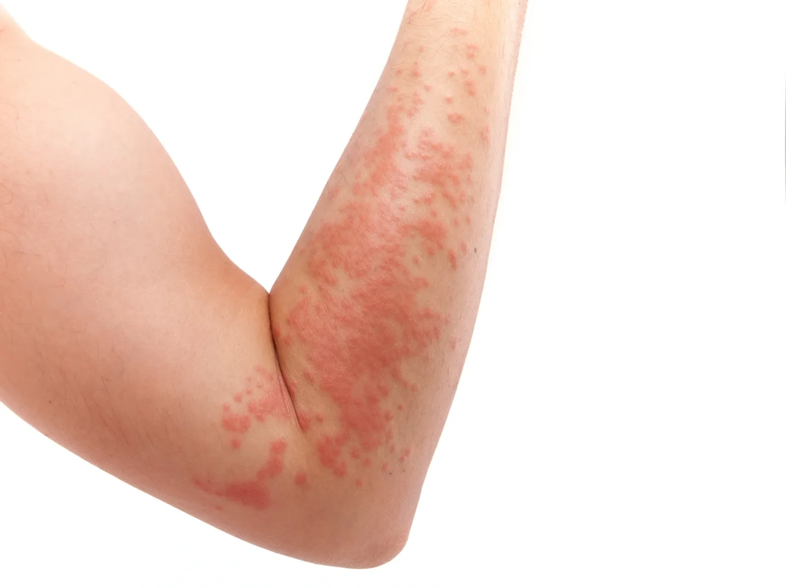 Diamine Oxidase and Hives: The Pathway to Relief