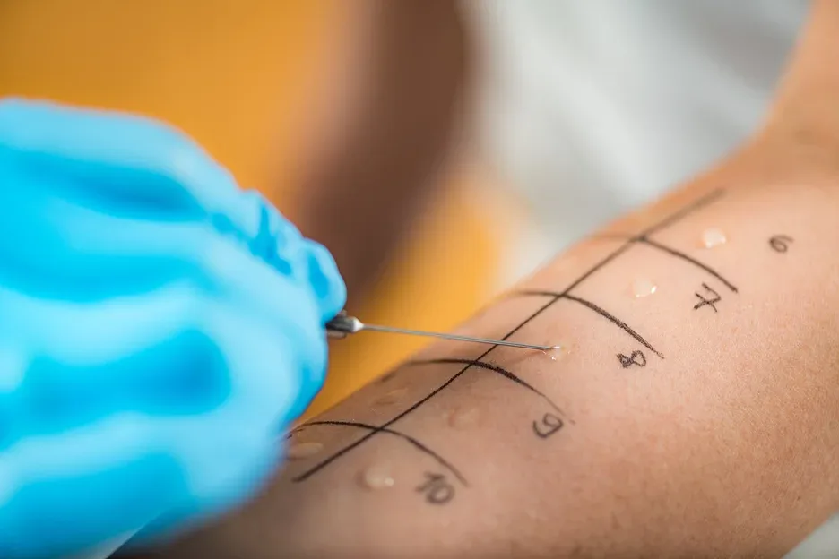 skin prick testing for allergy
