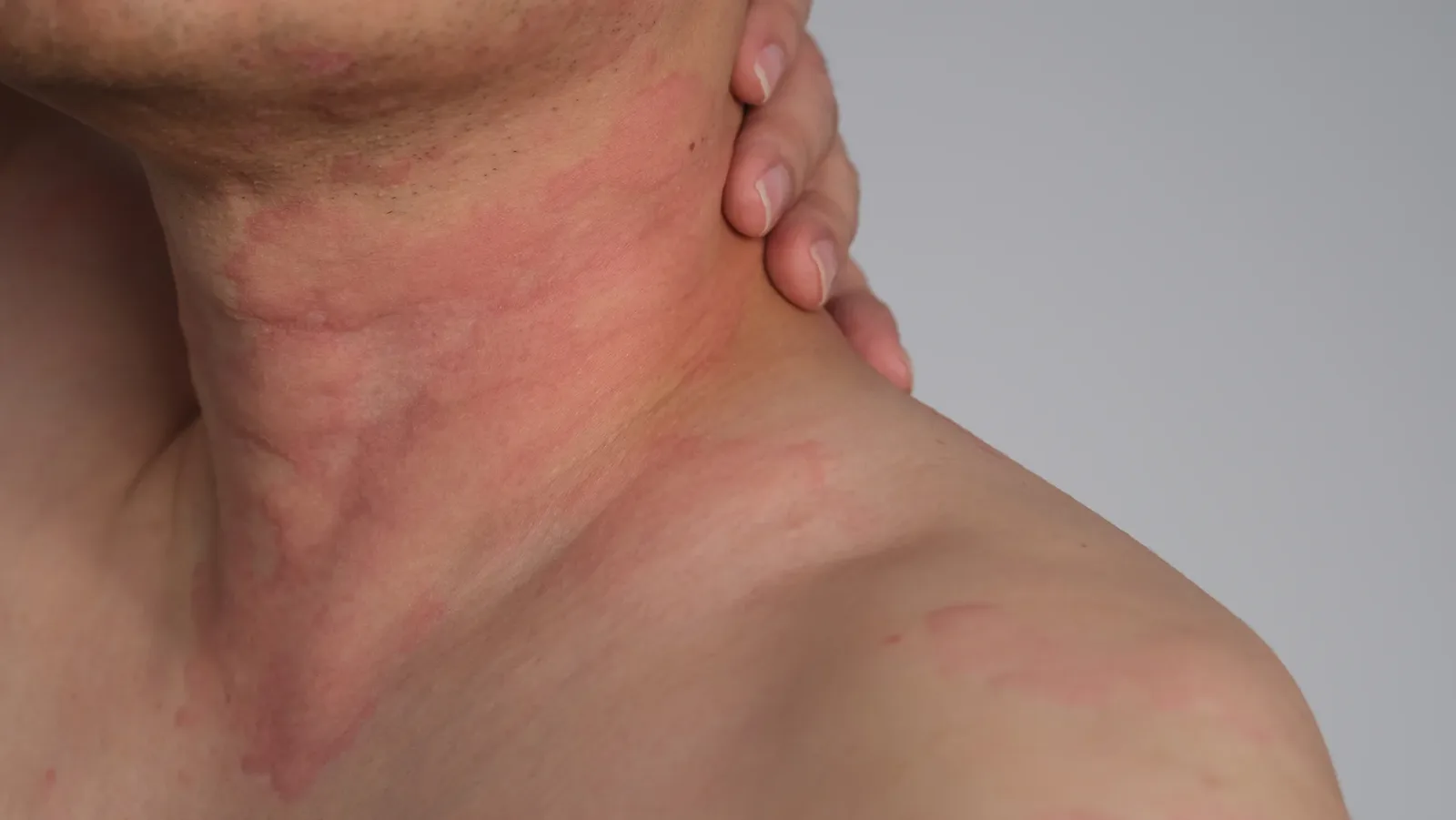 Histamine Intolerance: Mast Cells and Low DAO Activity