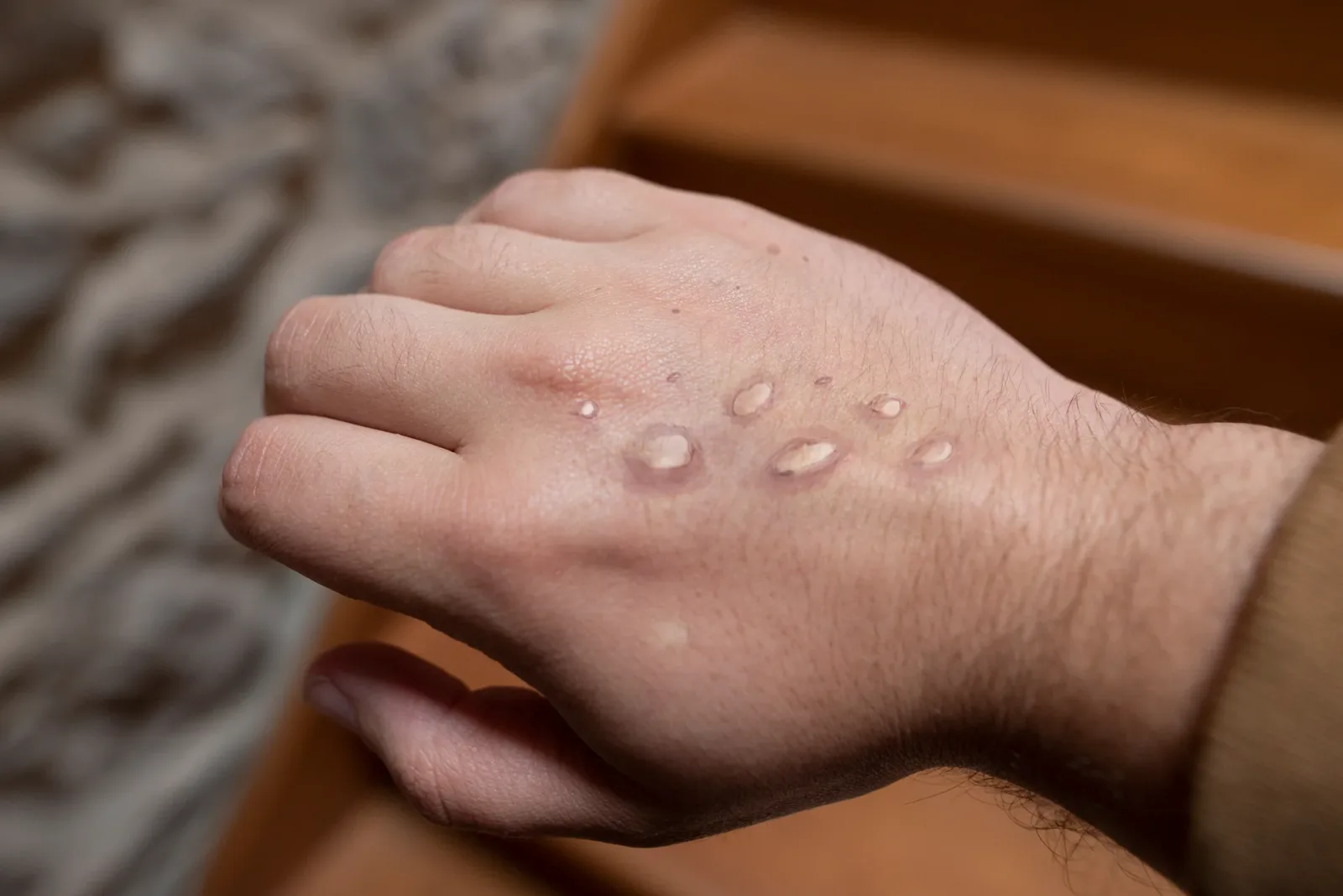 Natural Immunity to Smallpox and Its Implications