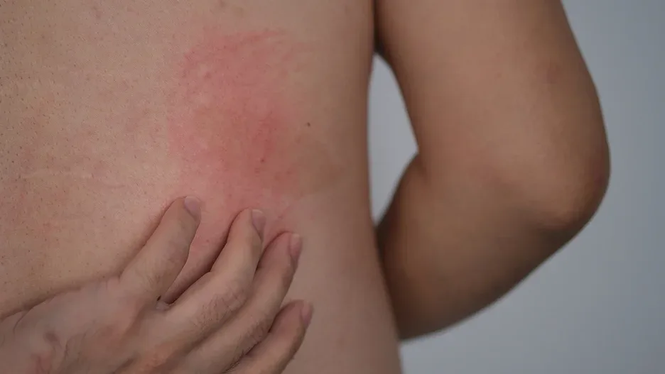 hives condition