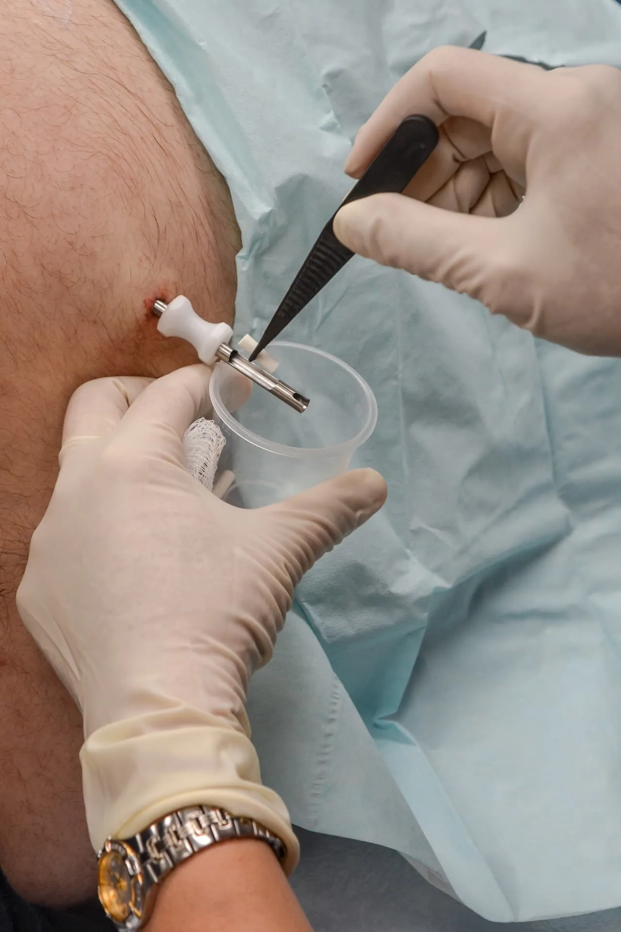 Testosterone Pellet Therapy