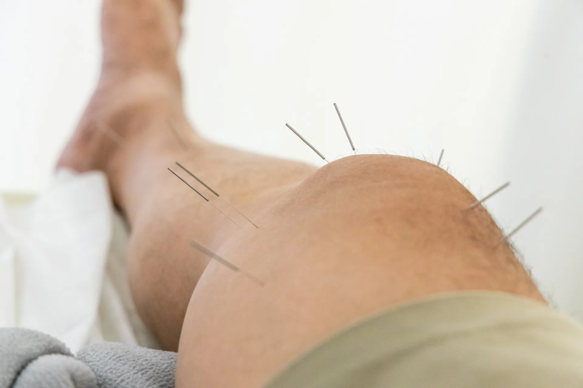 Close-up of acupuncture needles inserted around a patient's knee and lower leg
