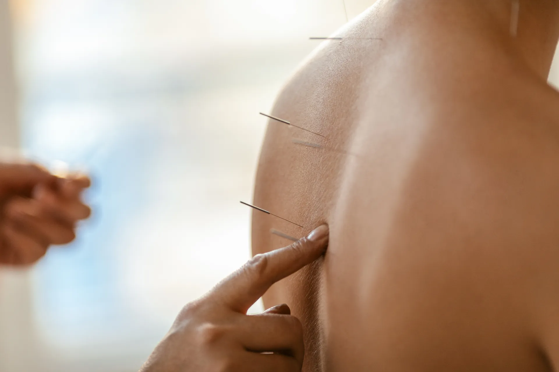 Practitioner placing fine acupuncture needles along a patient's back and shoulder