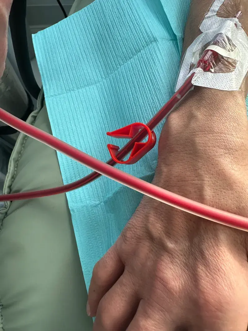 Close-up of a patient's forearm with an IV line carrying blood through red tubing