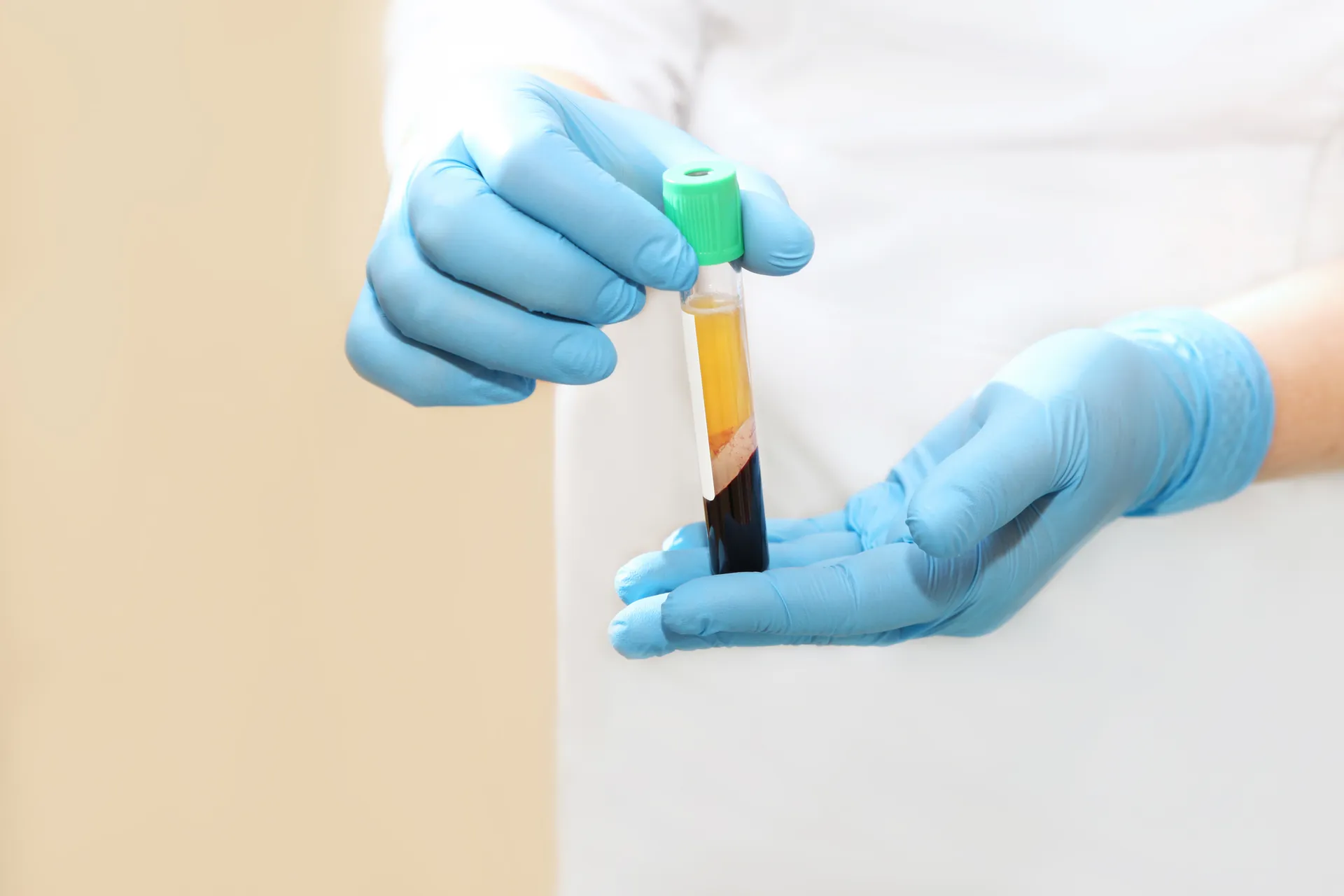 Gloved hands hold a tube of blood separated into plasma and red cells
