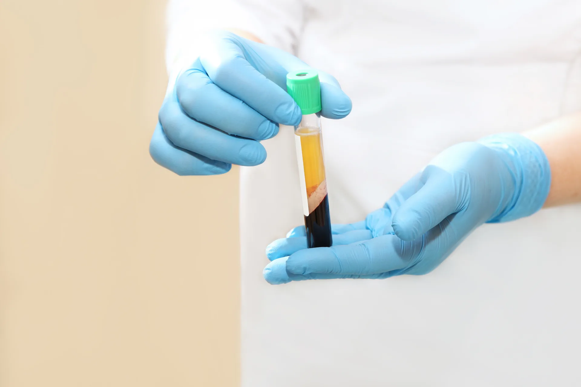 Gloved hands holding a tube of blood separated into plasma and red cell layers