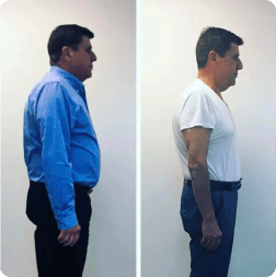 Before and after weight loss result — patient 2