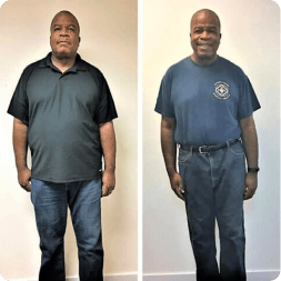 Before and after weight loss result — patient 4